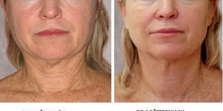 Thermolift a remodelácia tváre, brady, krku a dekoltu. Bonus - aplikácia 95 % kyslíka