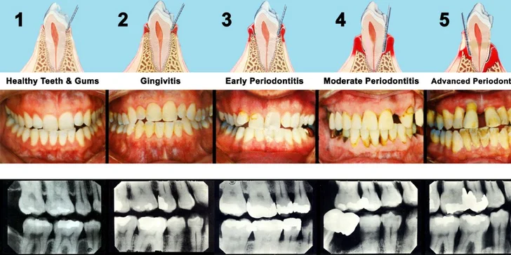 29 eur za kompletnú dentálnu hygienu. Zdravý chrup a žiarivý úsmev, so zľavou až 61 %!