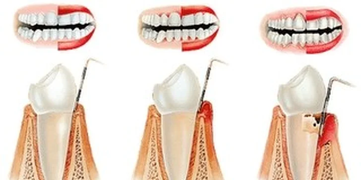29 eur za kompletnú dentálnu hygienu. Zdravý chrup a žiarivý úsmev, so zľavou až 61 %!