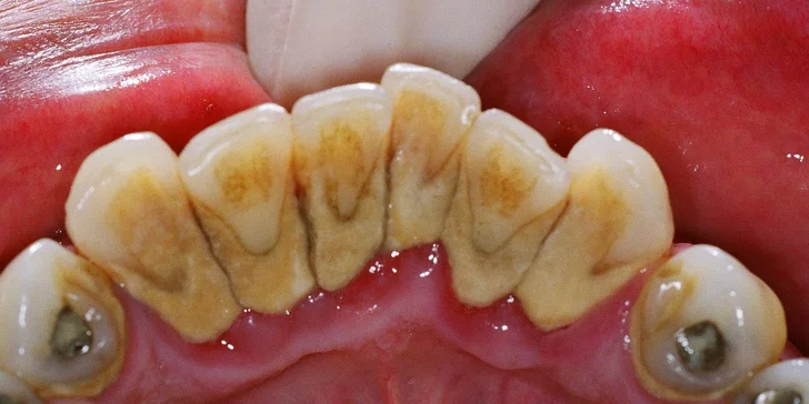 29 eur za kompletnú dentálnu hygienu. Zdravý chrup a žiarivý úsmev, so zľavou až 61 %!