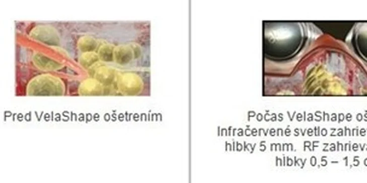 19,99 eur za odstránenie celulitídy ošetrením s technológiou VelaShape, ktorú vyhľadávajú aj svetové hviezdy. Nechajte vyniknúť krásnu a napnutú pokožku v bikinách a sexi letných šatočkách už toto leto so zľavou 84%!