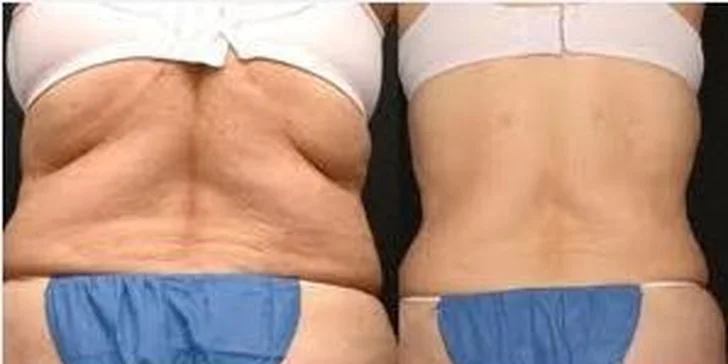 Novinka roku 2012 – LipoLaser Strong nahradil všetky neinvazívne metódy liposukcie. Uvádzacia cena 49,9 euro. Až 82 % z doporučenej ceny 289 euro!