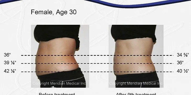 47,90 eur za krásnu a súmernú postavu vďaka unikátnej procedúre Lipolaser! Ošetrenie 10 oblastí tela naraz. OKAMŽITÉ a TRVALÉ výsledky porovnateľné s liposukciou. Zľava 84 %!