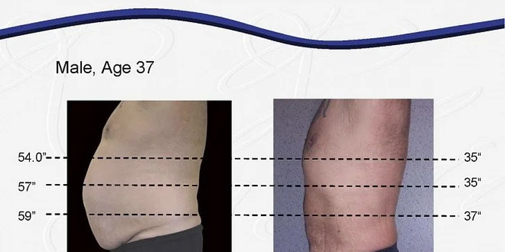 47,90 eur za krásnu a súmernú postavu vďaka unikátnej procedúre Lipolaser! Ošetrenie 10 oblastí tela naraz. OKAMŽITÉ a TRVALÉ výsledky porovnateľné s liposukciou. Zľava 84 %!