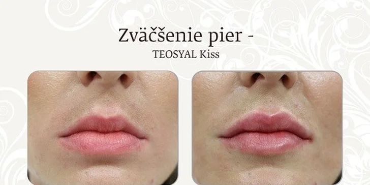 Zväčšenie pier „Teosyal Kiss“ kyselinou hyalurónovou