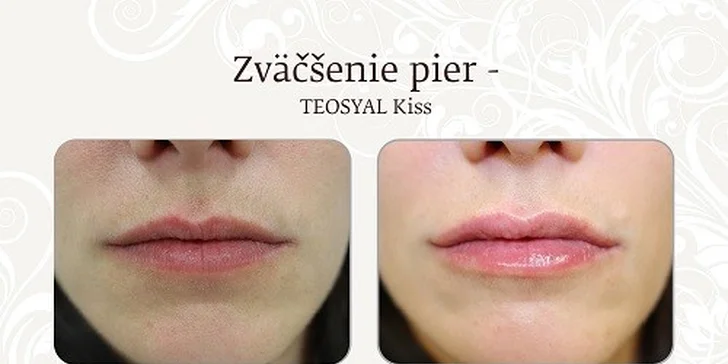 Zväčšenie pier „Teosyal Kiss“ kyselinou hyalurónovou