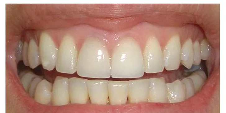 Bielenie zubov Ultradent – Opalescente Boost PF
