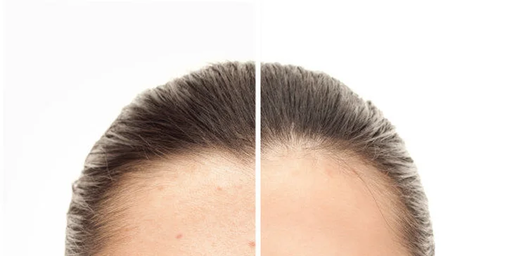 Fotomladenie (fotorejuvenizácia) - IPL