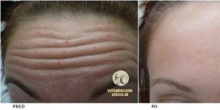 Odstránenie mimických vrások botulotoxínom