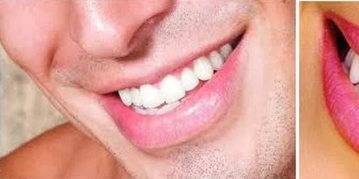 Dentálna hygiena - predíďte zbytočným zdravotným problémom a majte úsmev žiariaci zdravím