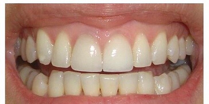 Top ambulantná dentálna hygiena alebo bielenie zubov
