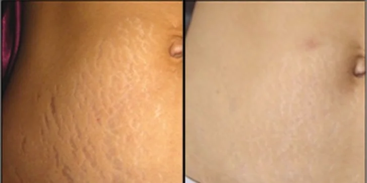 Frakčný resurfacing pre omladenie pleti