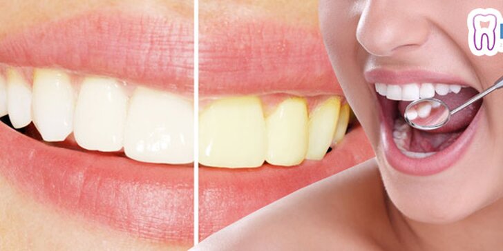 Bielenie zubov alebo diagnostické stomatologické vyšetrenie so získaním VIP členstva