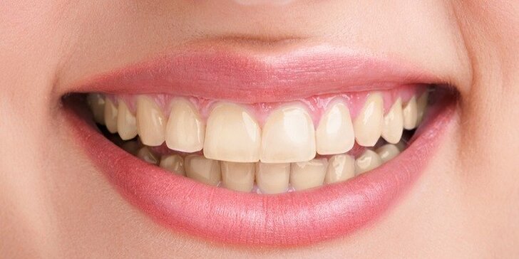 Citlivé bielenie zubov bez použitia peroxidu