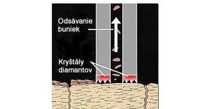 Profesionálna diamantová mikrodermabrázia