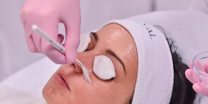 Chemický peeling TEOSYAL PEEL