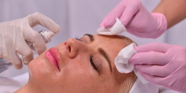 Chemický peeling TEOSYAL PEEL