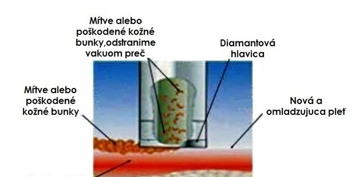 Vákuová diamantová mikrodermabrázia tváre