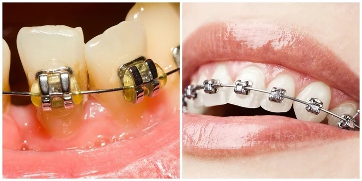 Dentálna hygiena a konzultácia s čeľustným ortopédom