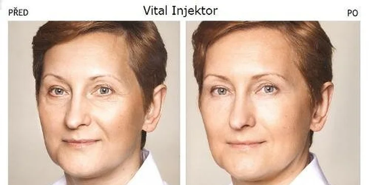 Mezolift aplikovaný Vital Injektorom s kyselinou hyalúronovou