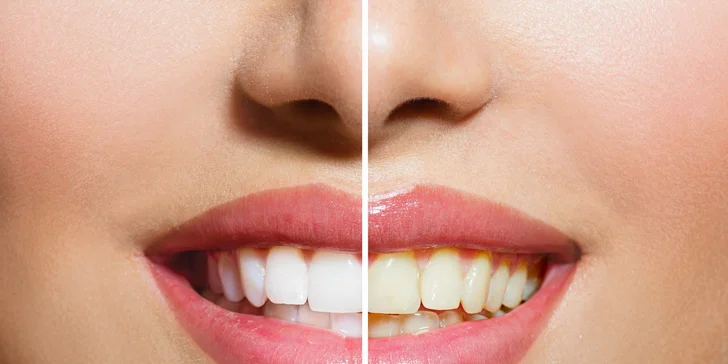 Dentálna hygiena s vyšetrením chrupu a ústnej dutiny skúseným stomatológom