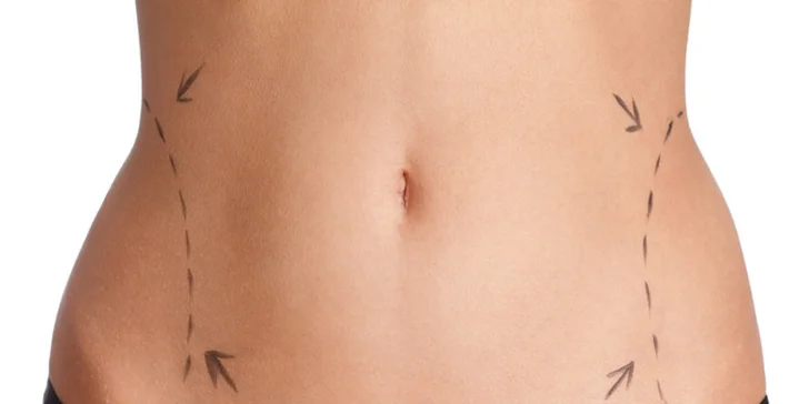 Neinvazívna liposukcia - Lipolaser + 10 minút na Vibračnej plošine