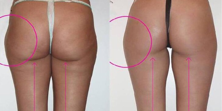 Štíhla s neinvazívnou liposukciou Vital Injector Lipolysis – Mesoline Slim & Bodyfirm