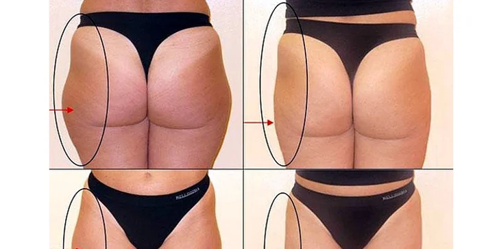 Štíhla s neinvazívnou liposukciou Vital Injector Lipolysis – Mesoline Slim & Bodyfirm
