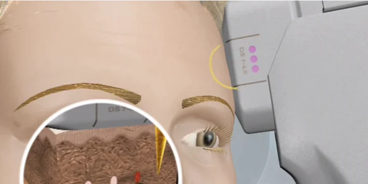 Nechirurgický facelifting čela a okolia očí