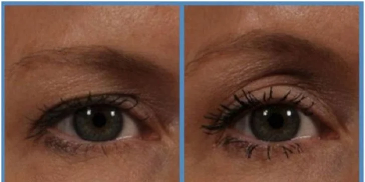 Nechirurgický facelifting čela a okolia očí