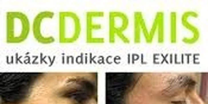 Odstránenie chĺpkov Fotoepiláciou medicínskou technológiou IPL Exilite II