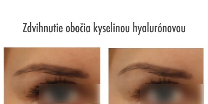Pozdvihnutie obočia kyselinou hyalurónovou