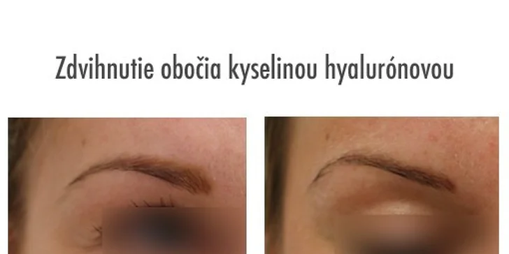 Pozdvihnutie obočia kyselinou hyalurónovou