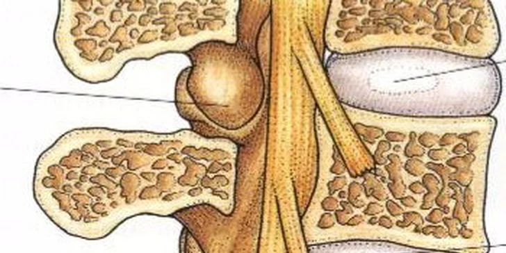 Kombinácia troch účinných masážnych techník, ktoré vám zaručene odstránia bolesť krčnej chrbtice