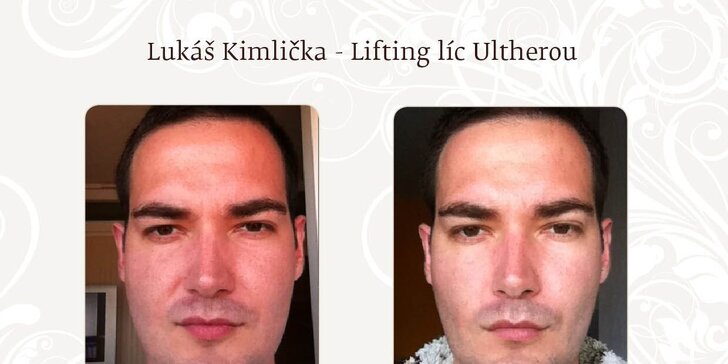 Ultherapia - nechirurgický dolný lifting líc pre mladistvú tvár