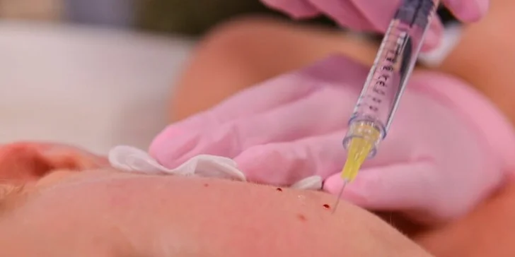 Efektívne omladenie kmeňovými bunkami "STEM CELL TREATMENT"
