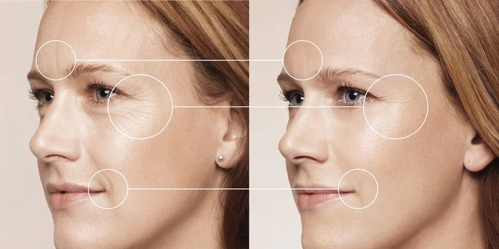 Unikátna vitamínova mezoterapia s Dermaheal HSR - OMLADZUJÚCA BOMBA