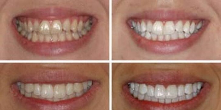 Predĺžené ošetrenie: Laserové bielenie zubov až 45 minút!