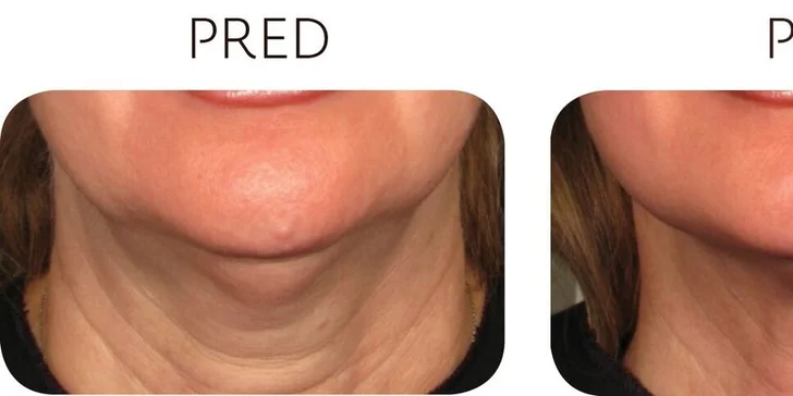 Ultherapia – nechirurgický facelift podbradku
