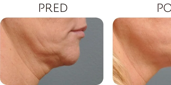 Ultherapia – nechirurgický facelift podbradku