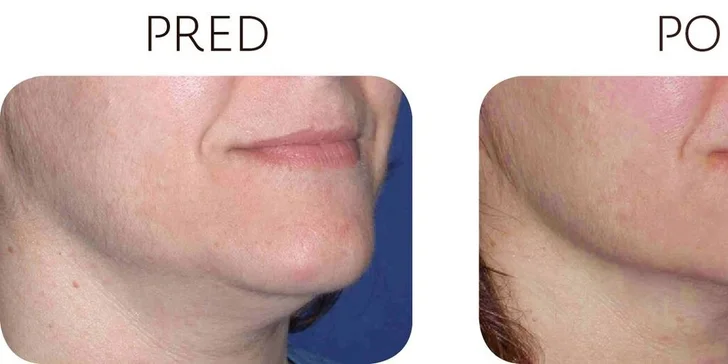 Ultherapia – nechirurgický facelift podbradku