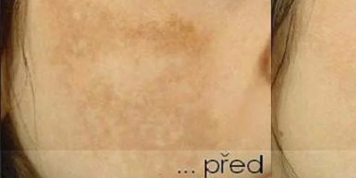 Pleť bez pigmentových škvŕn. Preliečte svoju pokožku!