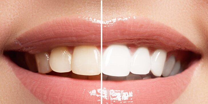 Profesionálne bielenie zubov bez peroxidu