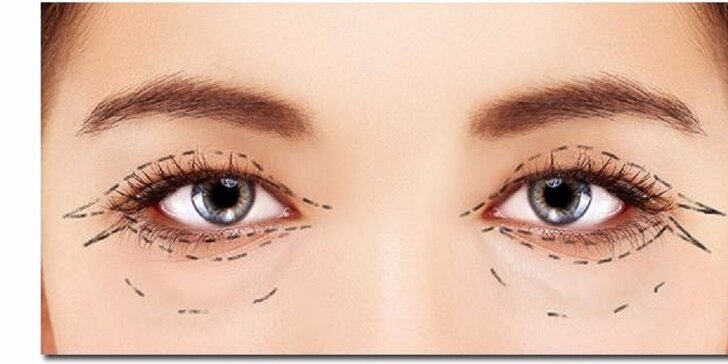 Neinvazívny lifting očných viečok a vačkov pod očami a ošetrenie dvojitej brady