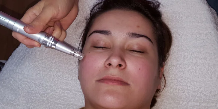 Omladzujúca mezoterapia kyselinou hyalurónovou
