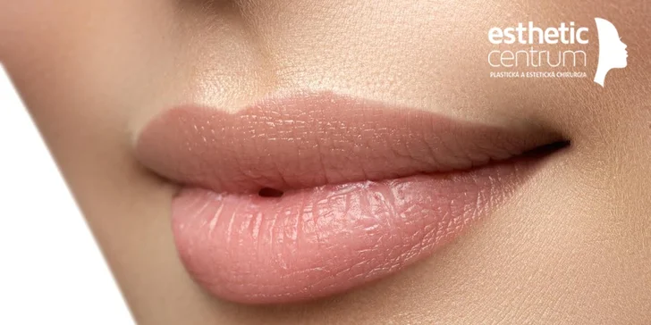 Zväčšenie pier s výplňou Princess® Filler aleboTeosyal Kiss PureSense