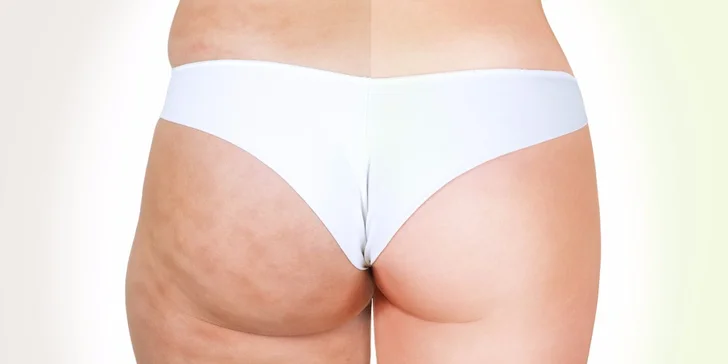 Lipolaser, kavitácia, rádiofrekvencia, vibračná plošina alebo Vacushape
