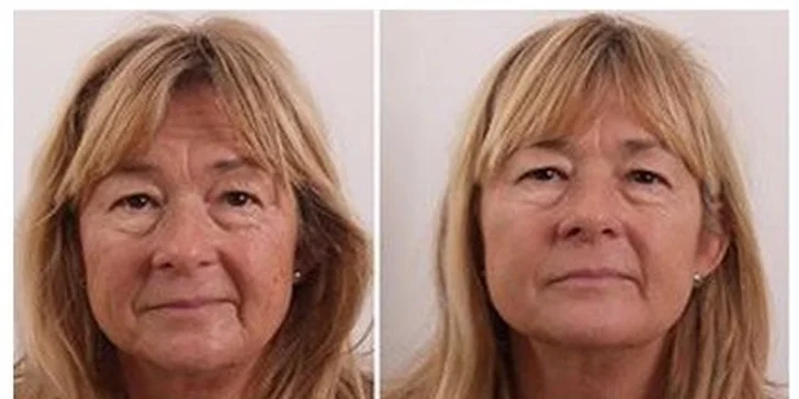 Ošetrenie pleti galvanickou žehličkou s vyživujúcou maskou z Kórey