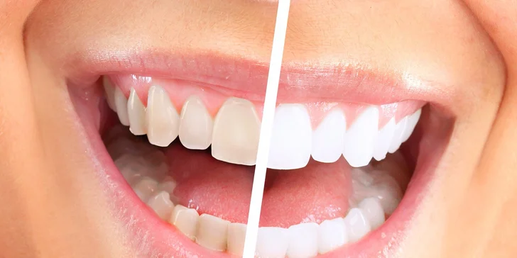 Dentálna hygiena alebo profesionálne bielenie zubov