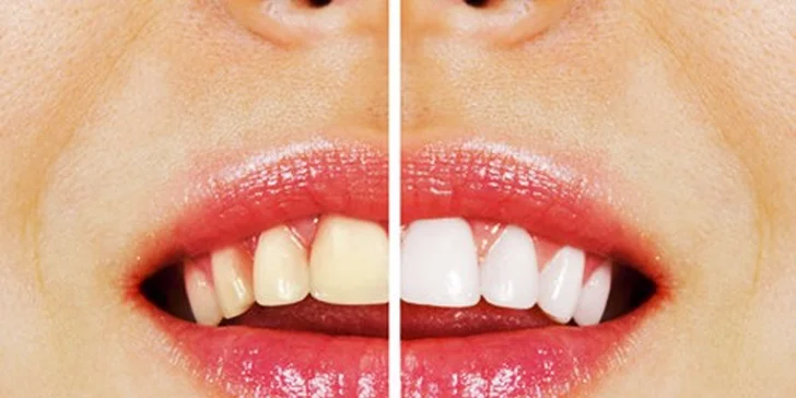 Top ambulantná dentálna hygiena s možnosťou bielenia - akcia za super cenu! Otvorené aj v SOBOTU!